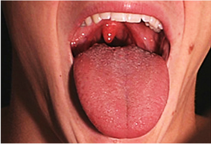 慢性肥厚性咽炎的癥狀