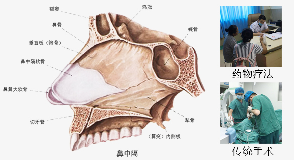 鼻中隔偏曲的治療方法