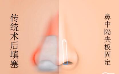 鼻中隔夾板術(shù)與傳統(tǒng)術(shù)后填塞對比
